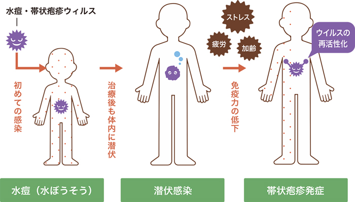 水痘・帯状疱疹ウィルスのイメージ